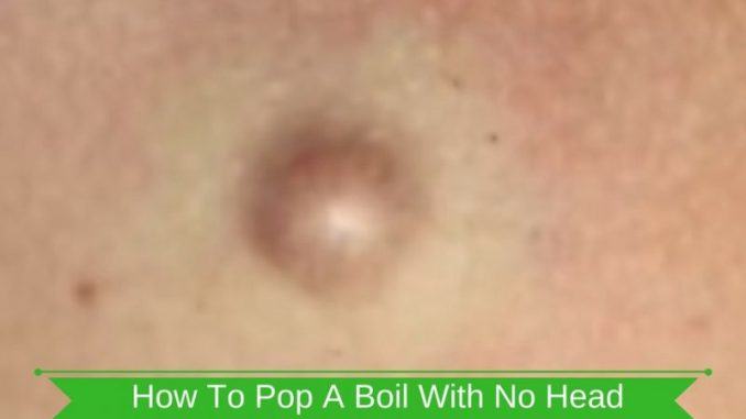 How-To-Pop-A-Boil-With-No-Head