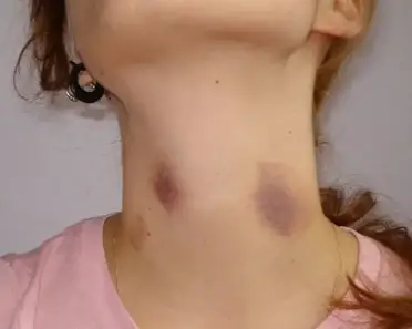 Looks breast red hickey like spot on Red Spot